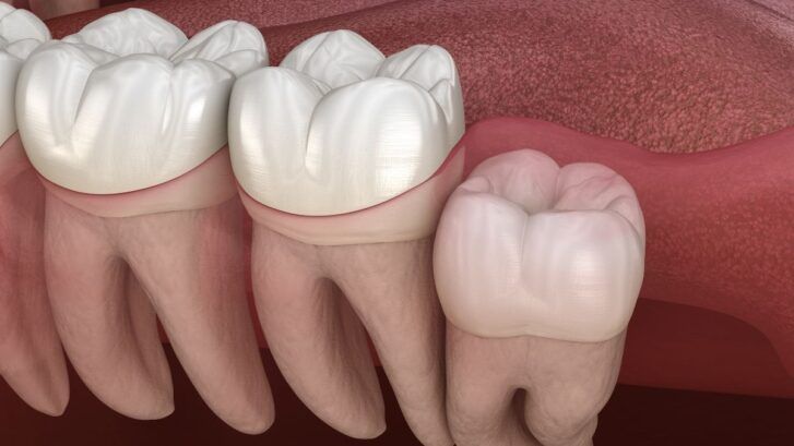 dientes impactados
