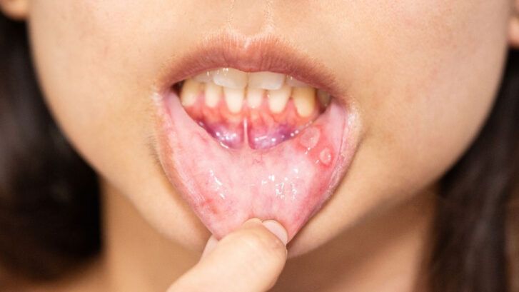 Mucositis: qué es y cómo se trata | BordonClinic