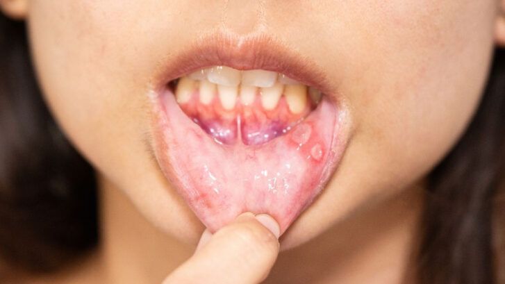 Mucositis: Qué Es Y Cómo Se Trata | BordonClinic