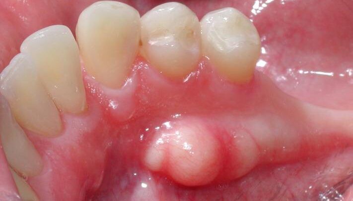 Torus Mandibularis: ¿Qué Es Y Por Qué Aparece? Torus Mandibularis: ¿Qué Es Y Por Qué Aparece? - Clínica Dental Bordonclinic
