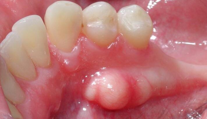 Torus mandibularis: ¿qué es y por qué aparece? | BordonClinic