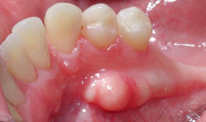 Torus Mandibularis: ¿qué Es Y Por Qué Aparece? - Clínica Dental BordonClinic