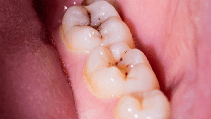 Tipos De Caries Dentales: Cuántos Tipos Hay Y Cómo Se Tratan Caries Dentales