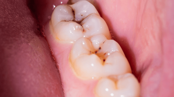 Caries dentales