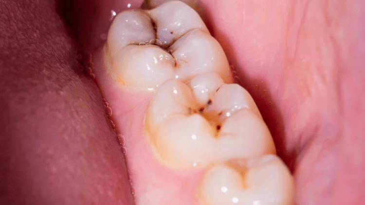 Caries dentales