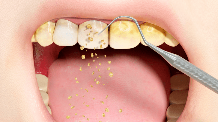 Cálculo dental