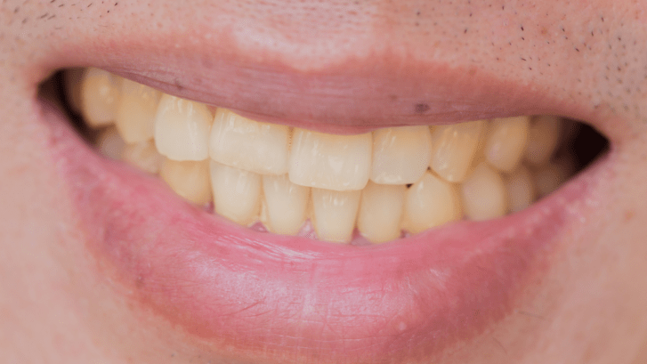 Tinciones dentales