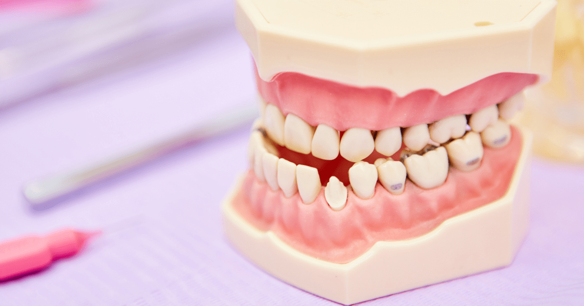 Mordida Abierta: ¿un Problema Estético O De Salud Dental? - Clínica Dental BordonClinic