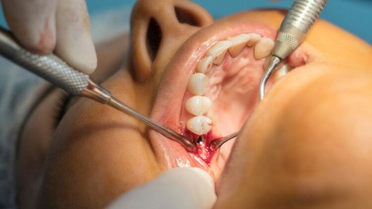 Implante dental infectado