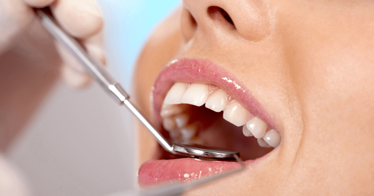 Placa Dental: Causas, Prevención Y Tratamiento - Clínica Dental BordonClinic