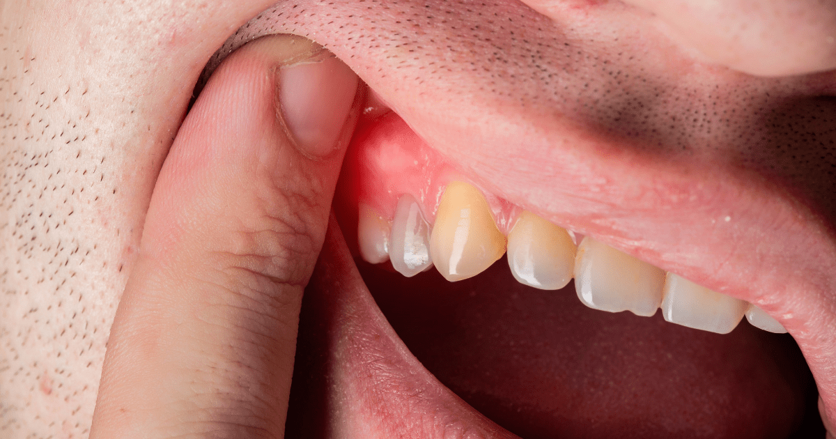 Absceso Periodontal: Síntomas, Tratamiento Y Prevención  - Clínica Dental BordonClinic