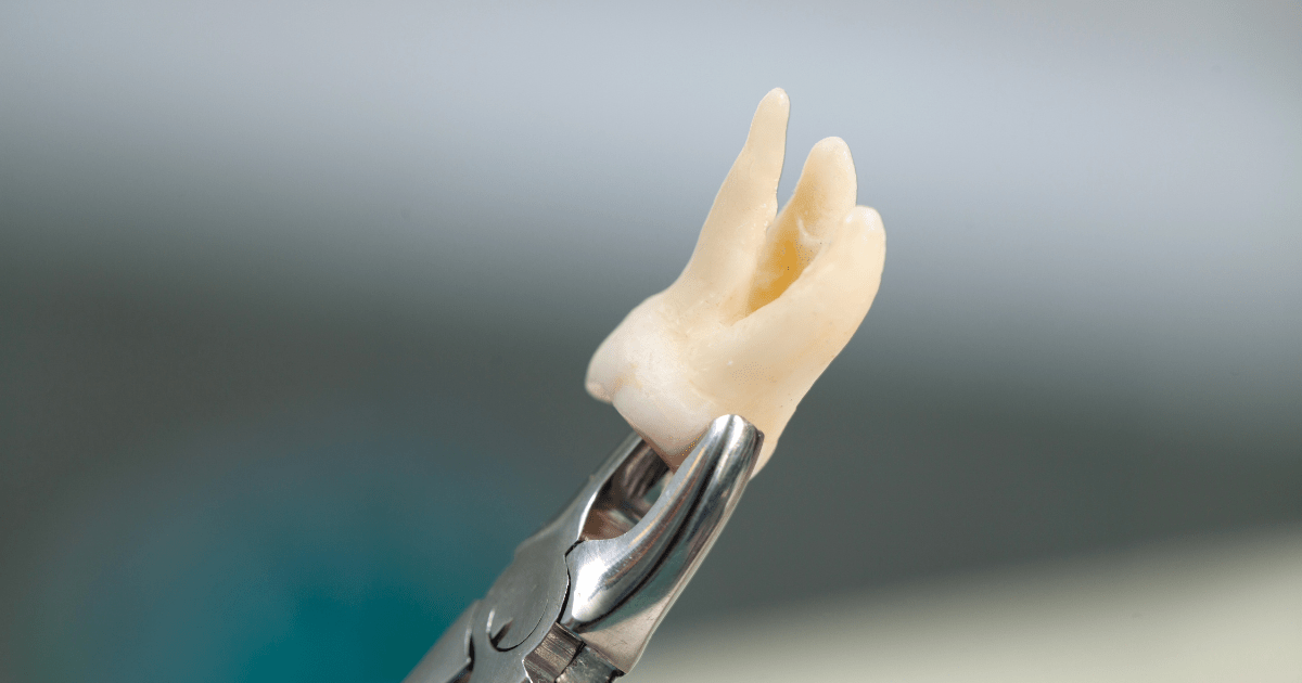 Traumatismo dental, fractura dental y reconstrucción dental: Cómo restaurar tu sonrisa | BordonClinic