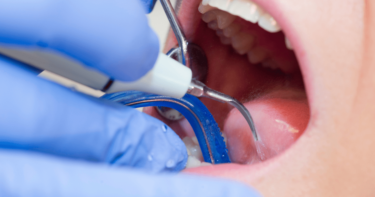 Cómo Prevenir El Sarro Dental: Consejos Y Tratamientos - Clínica Dental BordonClinic