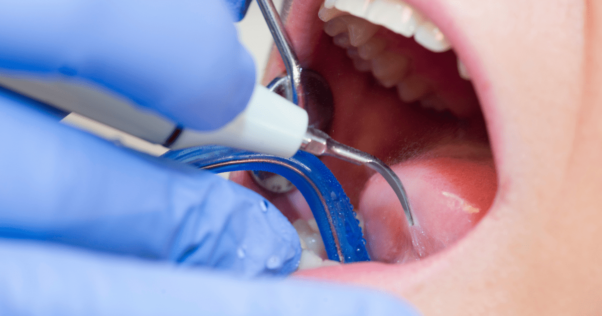 Cómo prevenir el sarro dental: consejos y tratamientos | BordonClinic