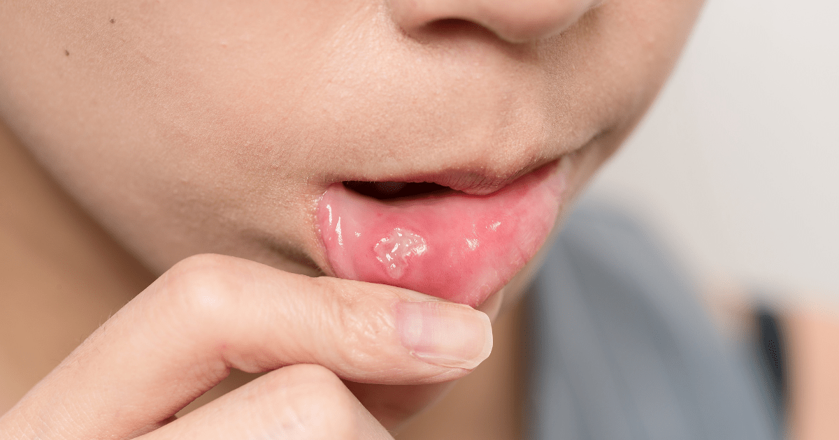 Muguet Oral: Qué es, causas, síntomas y tratamiento | BordonClinic