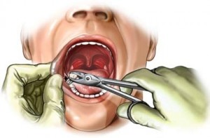 Extracción dental cuidados