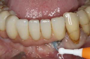 Como se limpian los implantes dentales
