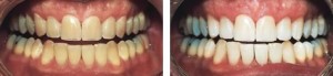 Resultados Reales Con Blanqueamiento Dental Combinado ZOOM