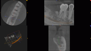Tac Dental: precisión en el diagnóstico | BordonClinic