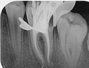 Imagen de endodoncia en molar superior
