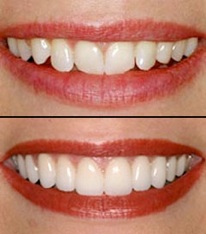 carillas dentales de composite carillas dentales de composite