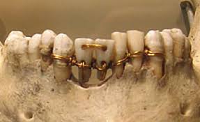 Implantes ligando con oro a los dientes adyacentes