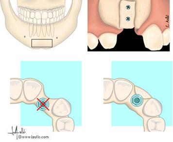 INJERTO EN BLOQUE DE HUESO | BordonClinic